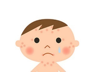 乳児湿疹なのかアトピーなのか その判断基準は ママ必見 乳児湿疹が顔に出来た赤ちゃんの治療と対策